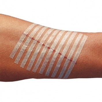 Wound Closures